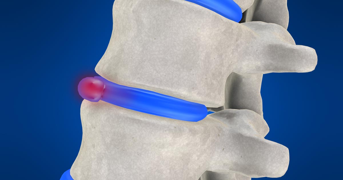 North County St. Louis, MO non-surgical disc herniation treatment