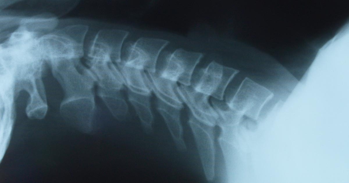 North County St. Louis, MO Back Pain Treatment without Surgery